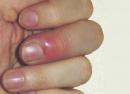 Гной на пальце ноги возле ногтя: причины, способы лечения